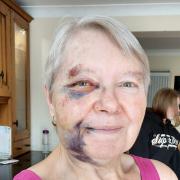 Gillian Bartram suffered a bad fall in Dereham last week, breaking the orbital bone below her eye.
